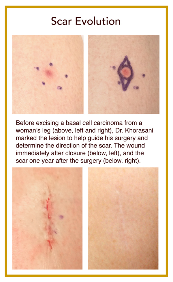 basal cell carcinoma excision and scar