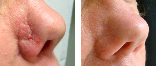 Scar Prevention/ Treatment — Dermatology Skin Cancer Experts
