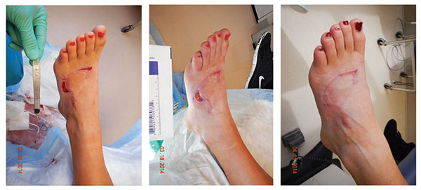 Scar on foot healing journey