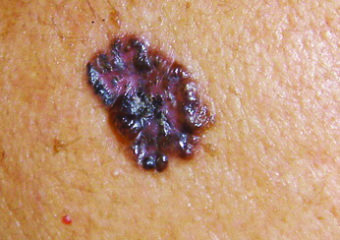 basal cell carcinoma on arm
