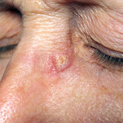 Focus on Eyelid Skin Cancers: Early Detection and Treatment - The Skin ...