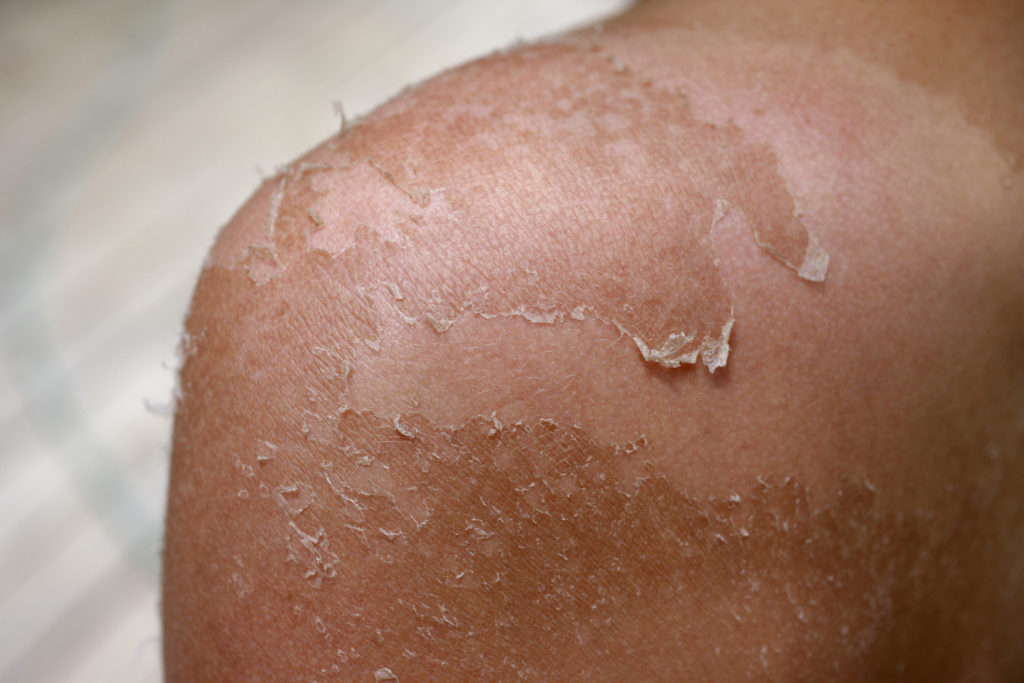 Ask The Expert What Should I Do If I Get A Blistering Sunburn The Skin Cancer Foundation