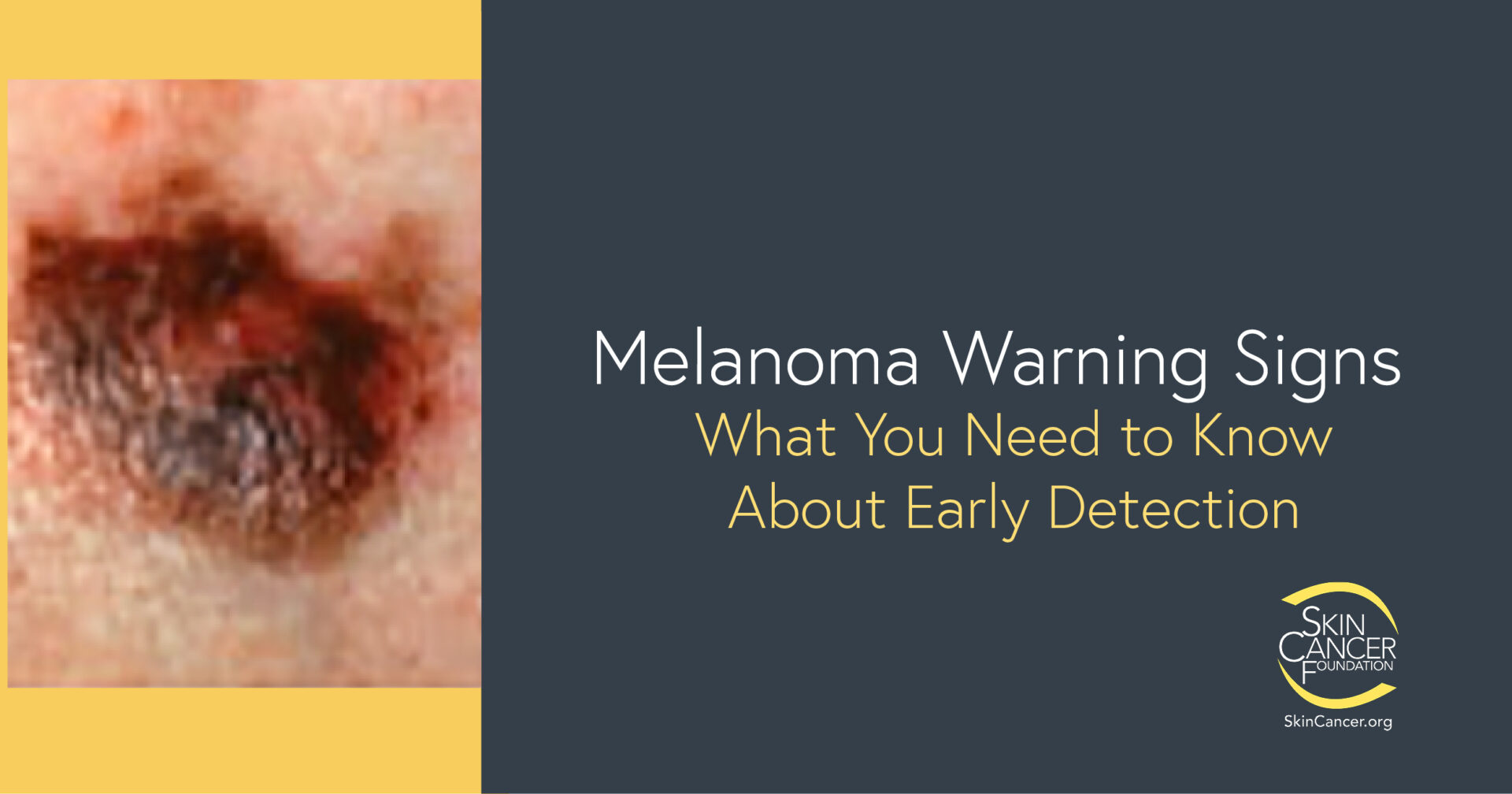 Melanoma Warning Signs and Images - The Skin Cancer Foundation