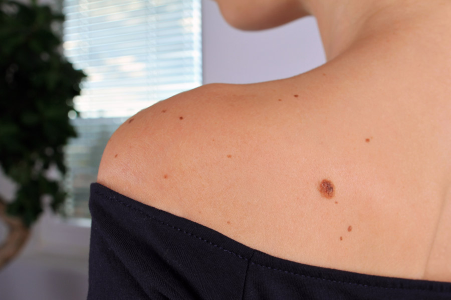 Ask the Expert: Painful Moles - The Skin Cancer Foundation