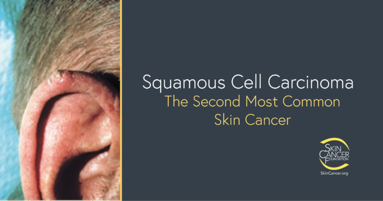 Man's ear with squamous cell carcinoma