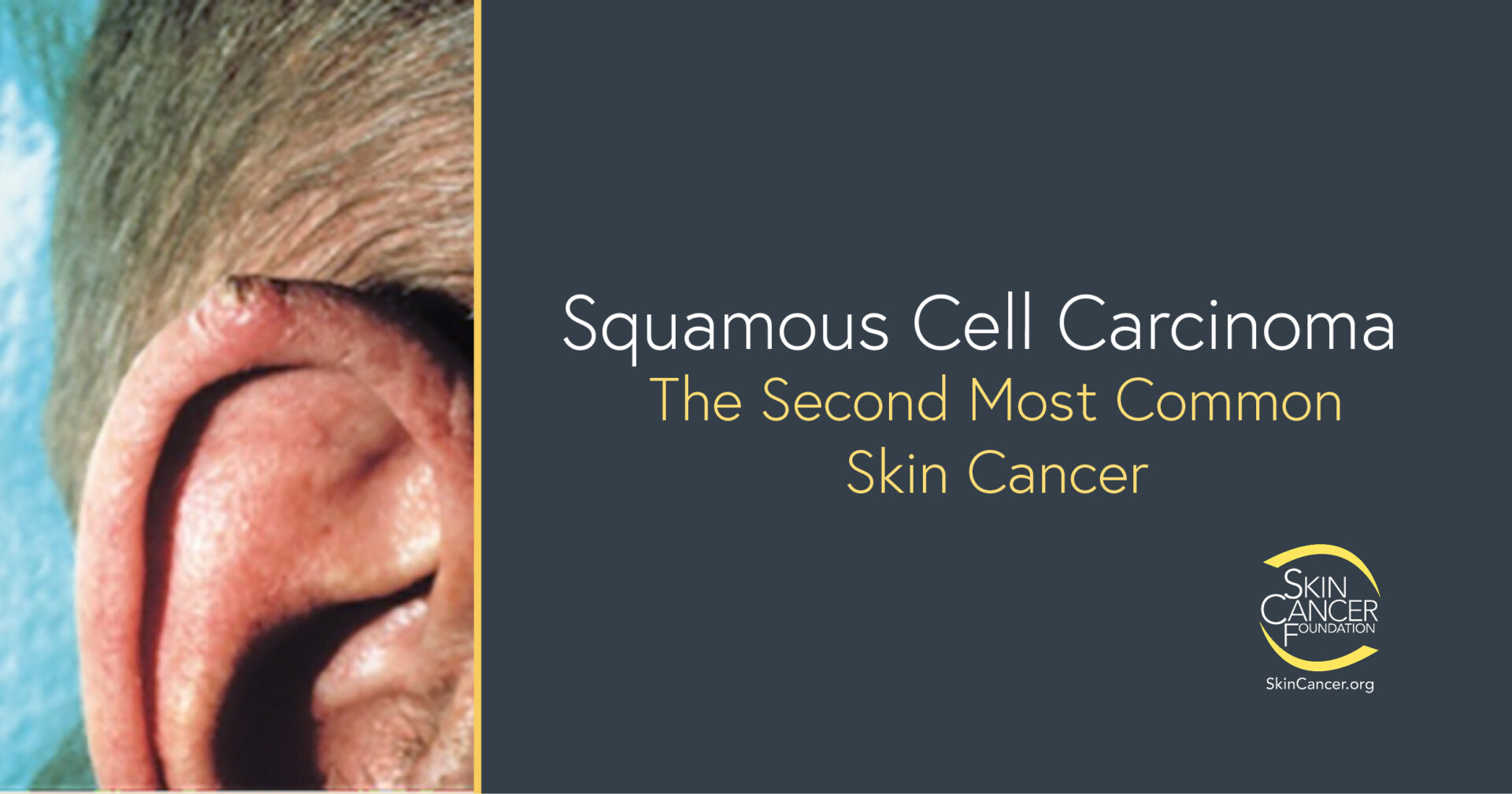 Squamous Cell Carcinoma - The Skin Cancer Foundation