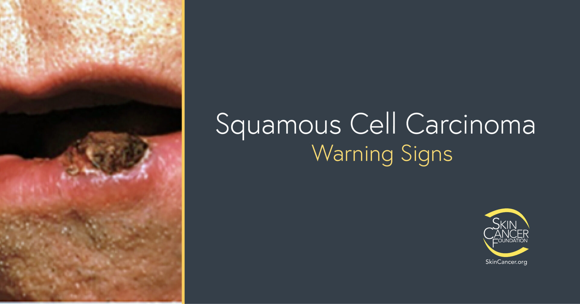 squamous cell carcinoma mouth