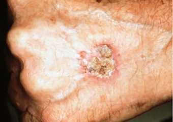 basal cell carcinoma vs squamous cell carcinoma