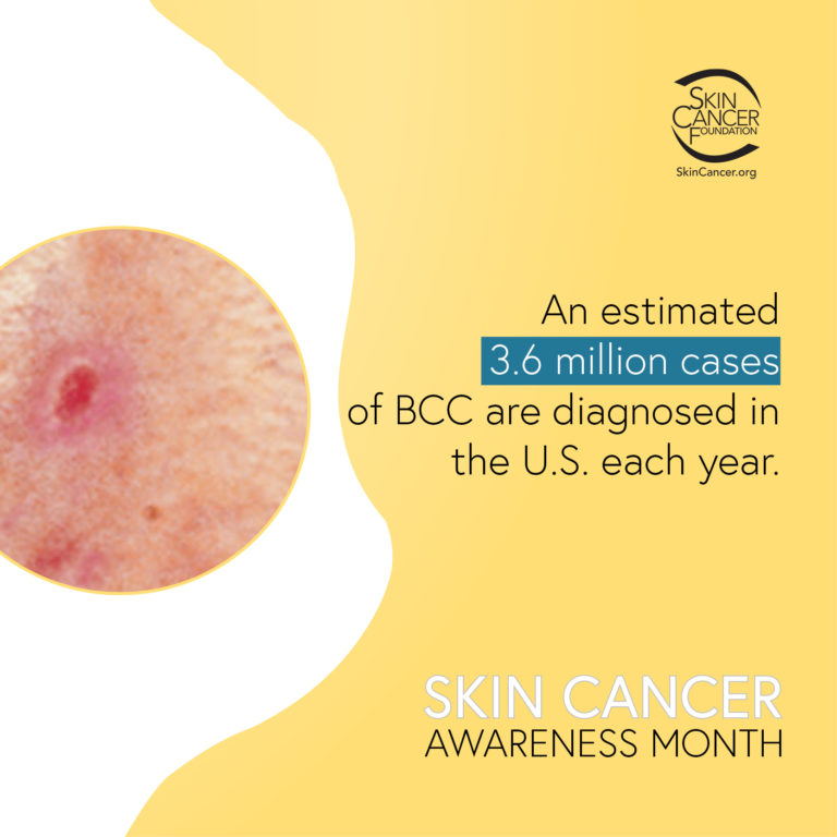 Skin Cancer Awareness Month Toolkit