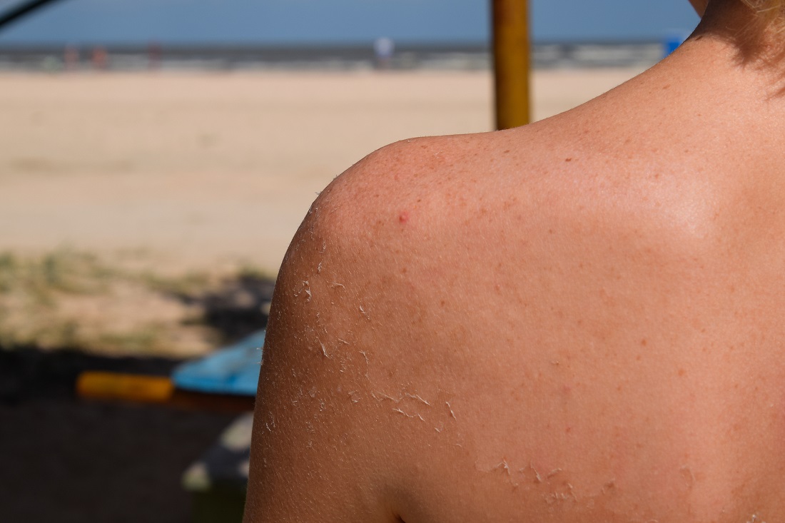Why Does My Skin Peel When I Get Sunburned, and What Should I Do