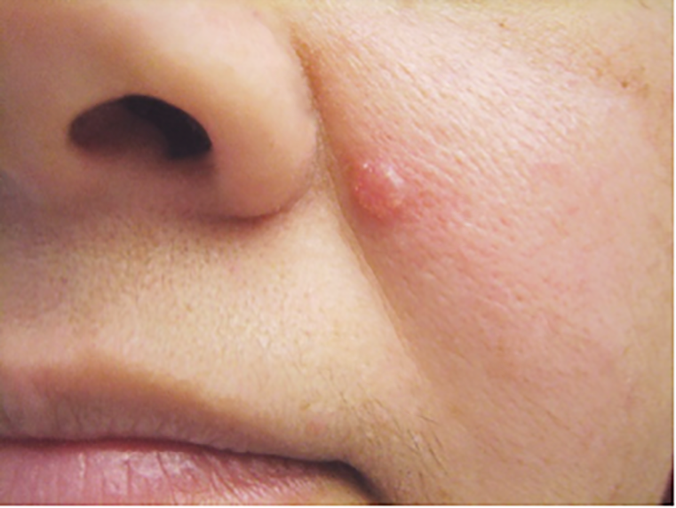 basal cell carcinoma lip