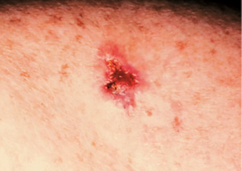 tumor skin lesion