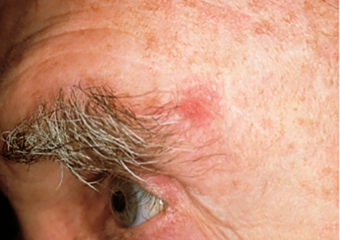reddish patch on man's forehead basal cell carcinoma
