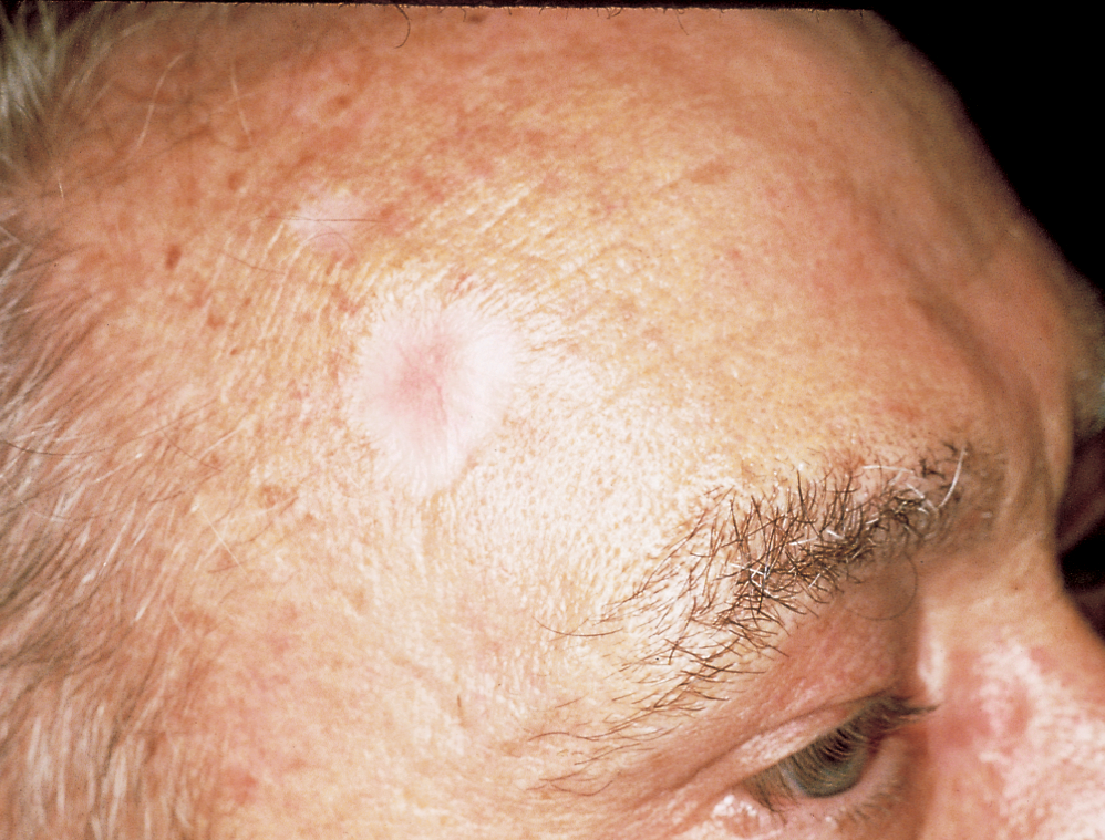 Basal Cell Carcinoma 4 Scar 
