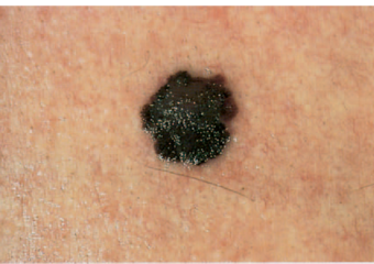 How to spot a melanoma — Dermatology Arts